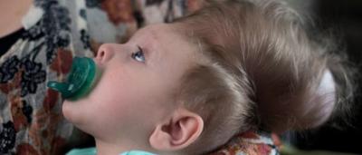 Ce Bebe Ne Avec Le Cerveau Hors Du Crane Survit Miraculeusement Video Sudinfo Be