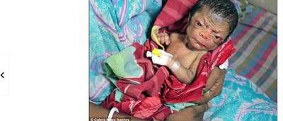 Un Bebe Vient Au Monde Avec L Apparence D Un Vieux De 80 Ans Sudinfo Be Un Bebe Vient Au Monde Avec L Apparence D Un Vieux De 80 Ans Sudinfo Be