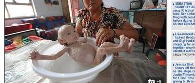 Ce Nourrisson Est Appele Le Bebe Alien L Enfant Est Ne Sans Rectum Sudinfo Be Ce Nourrisson Est Appele Le Bebe Alien L Enfant Est Ne Sans Rectum Sudinfo Be